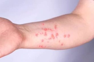 Mpox: Brasil registra 140 casos em 2026